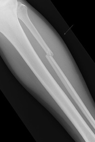 X-rays