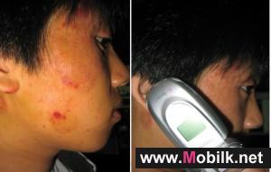 Cell Phones Linked to Skin Allergies